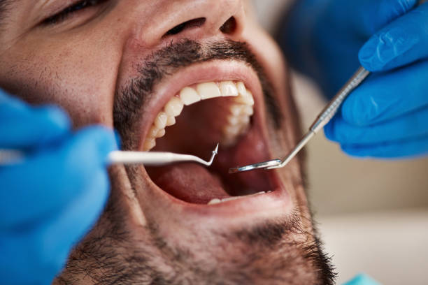 Best Emergency Wisdom Tooth Extraction in Gardner, KS